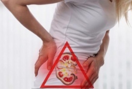 تعرف على أعراض حصوات الكلى وكيفية الوقاية منها