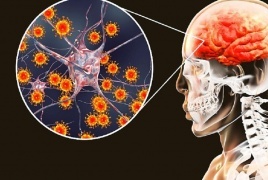 أعراض وتشخيص مرض التهاب السحايا