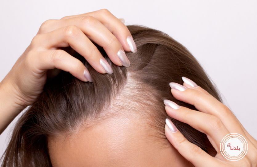 دواء فموي جديد يحقق نتائج واعدة لنمو الشعر في 6 أشهر